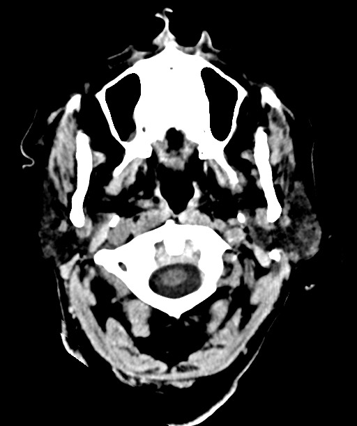 Bilateral acute on chronic subdural hematomas (Radiopaedia 78466-91146 Axial non-contrast 7).jpg