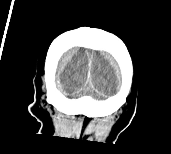 Bilateral acute on chronic subdural hematomas (Radiopaedia 78466-91146 Coronal non-contrast 62).jpg
