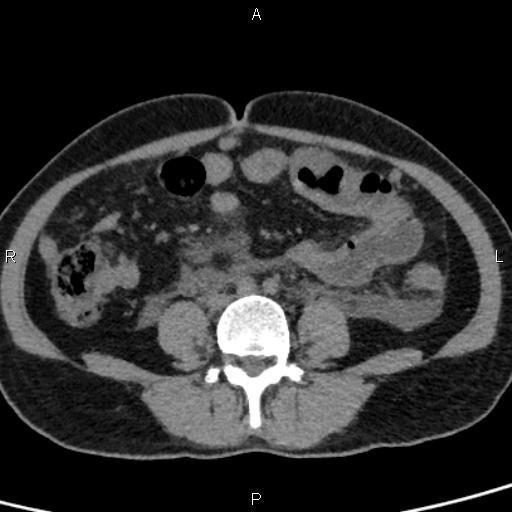 Bilateral adrenal gland hyperenhancement in pancreatitis (Radiopaedia 86642-102753 Axial non-contrast 71).jpg