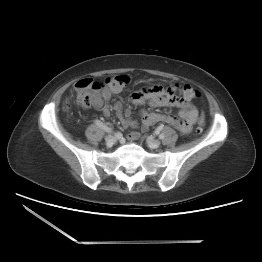 Bilateral adrenal granulocytic sarcomas (chloromas) (Radiopaedia 78375-91007 A 82).jpg