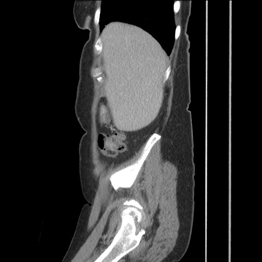 Bilateral adrenal granulocytic sarcomas (chloromas) (Radiopaedia 78375-91007 C 34).jpg