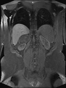 Bilateral adrenal myelolipoma (Radiopaedia 63058-71537 Coronal T1 fat sat 25).jpg
