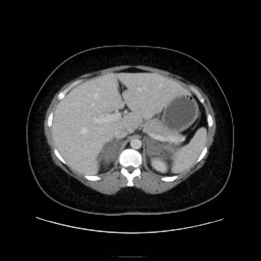 Bilateral adrenal thrombosis (Radiopaedia 58182-65256 A 17).jpg