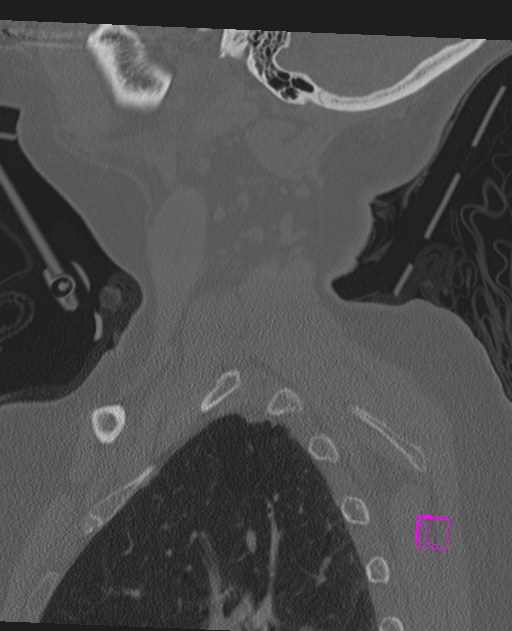 Bilateral atlanto-occipital assimilation (Radiopaedia 28350-28603 Sagittal bone window 10).jpg