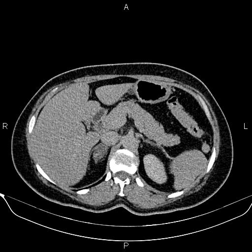 Bilateral benign adrenal adenomas (Radiopaedia 86912-103124 Axial C+ delayed 33).jpg