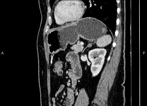 Bilateral benign adrenal adenomas (Radiopaedia 86912-103124 E 67).jpg