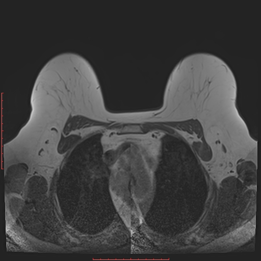 File:Bilateral breast implant rupture (Radiopaedia 24761-25027 T1 10).jpg