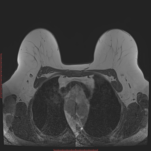 File:Bilateral breast implant rupture (Radiopaedia 24761-25027 T1 11).jpg