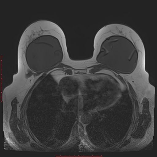 File:Bilateral breast implant rupture (Radiopaedia 24761-25027 T1 22).jpg