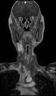 File:Bilateral carotid body tumors and right glomus jugulare tumor (Radiopaedia 20024-20060 MRA 10).jpg