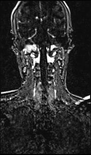 File:Bilateral carotid body tumors and right glomus jugulare tumor (Radiopaedia 20024-20060 MRA 121).jpg
