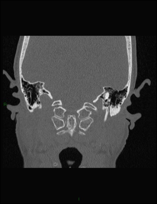 Bilateral frontal mucoceles (Radiopaedia 82352-96454 Coronal 328).jpg