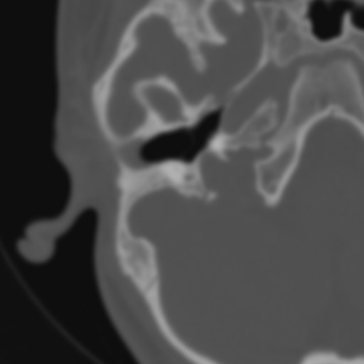 Bilateral otosclerosis (Radiopaedia 57237-64157 B 44).jpg