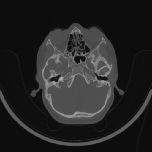 Bilateral otosclerosis (Radiopaedia 57237-64157 C 36).jpg