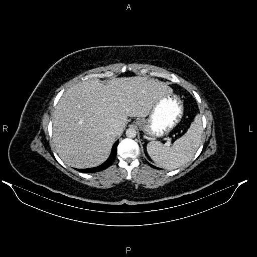 Bilateral ovarian dermoid cysts (Radiopaedia 85785-101603 A 22).jpg