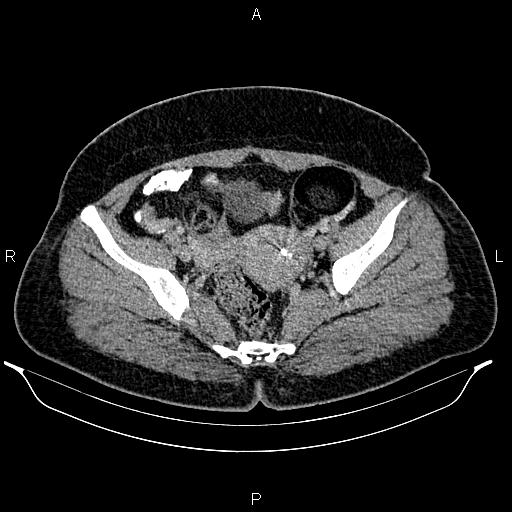 Bilateral ovarian dermoid cysts (Radiopaedia 85785-101603 A 89).jpg
