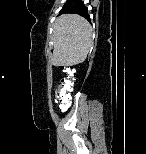 Bilateral ovarian dermoid cysts (Radiopaedia 85785-101603 D 10).jpg