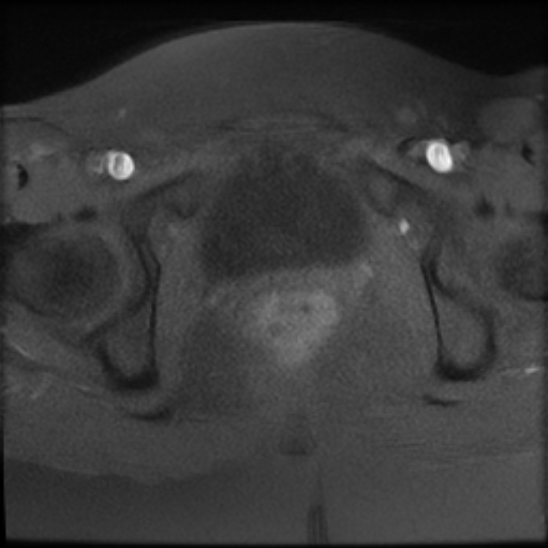 File:Bilateral ovarian fibrothecomas - adolescent (Radiopaedia 86604-102707 Axial T1 fat sat 25).jpg