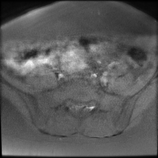 File:Bilateral ovarian fibrothecomas - adolescent (Radiopaedia 86604-102707 Axial T1 fat sat 6).jpg