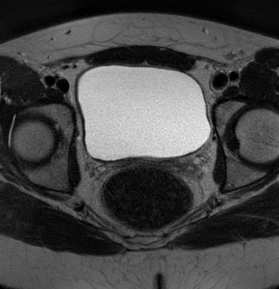 File:Bilateral ovarian fibrothecomas - adolescent (Radiopaedia 86604-102707 Axial T2 32).jpg
