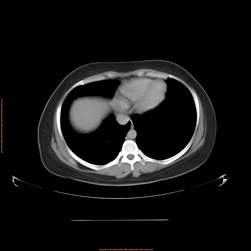 File:Bilateral ovarian serous cystadenocarcinoma with right ovarian torsion (Radiopaedia 32640-33611 A 4).jpg