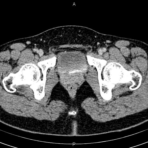 File:Bilateral ovarian teratoma (Radiopaedia 83131-97503 B 74).jpg