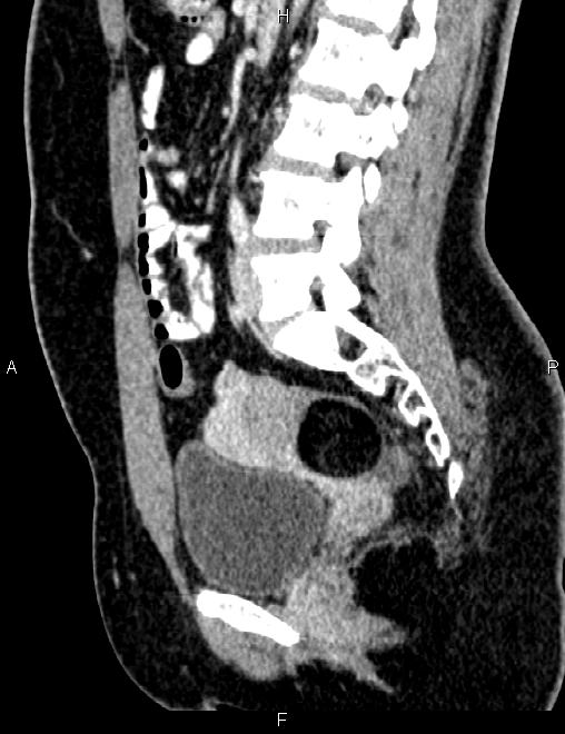 Bilateral ovarian teratoma (Radiopaedia 83131-97503 D 67).jpg