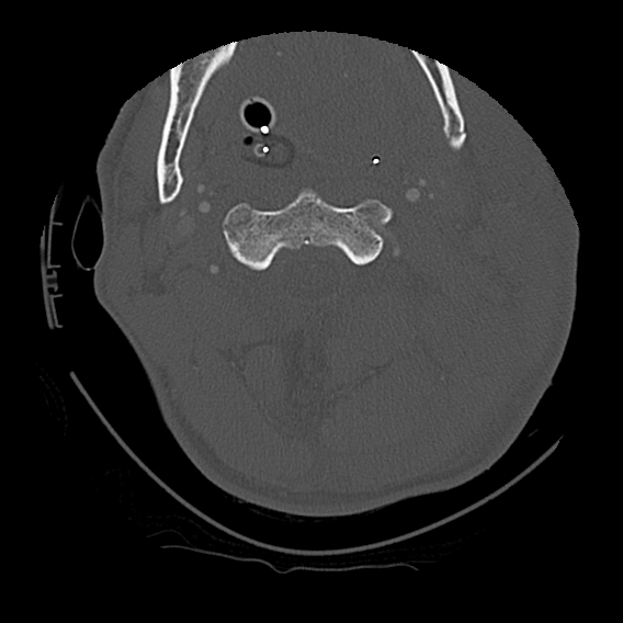 File:Bilateral perched facets with cord injury (Radiopaedia 45587-49713 Axial bone window 36).jpg