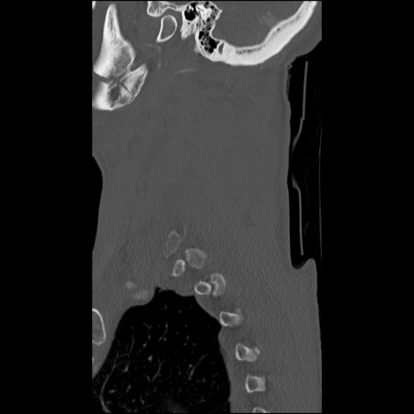 Bilateral perched facets with cord injury (Radiopaedia 45587-49713 Sagittal bone window 47).jpg