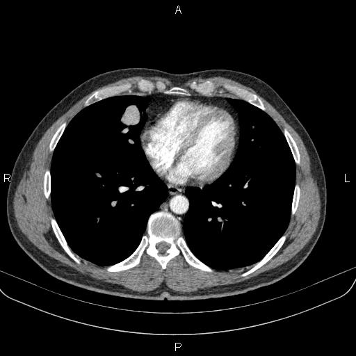 Bilateral pulmonary AVM (Radiopaedia 83134-97505 A 48).jpg