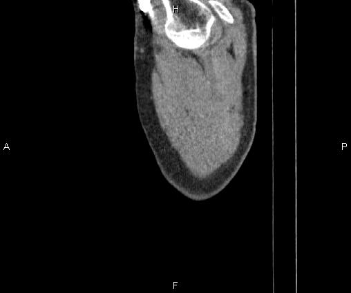 Bilateral pulmonary AVM (Radiopaedia 83134-97505 D 6).jpg