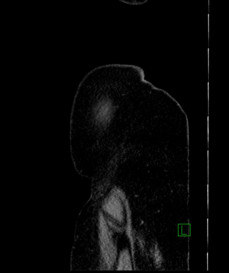 Bilateral sporadic synchronous clear cell renal cell carcinoma (Radiopaedia 85035-100575 E 7).jpg