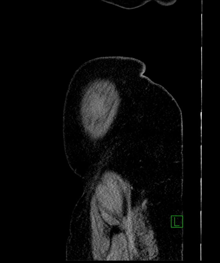 Bilateral sporadic synchronous clear cell renal cell carcinoma (Radiopaedia 85035-100575 E 9).jpg