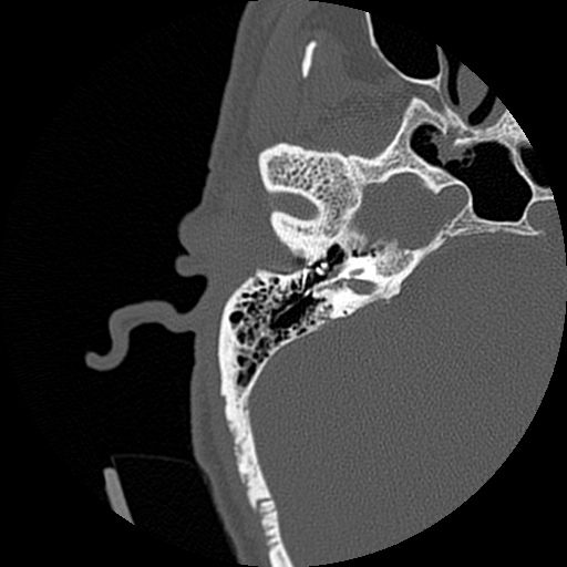 File:Bilateral temporal bone fractures (Radiopaedia 29482-29970 Axial non-contrast 29).jpg