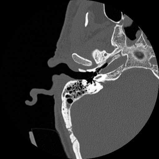 File:Bilateral temporal bone fractures (Radiopaedia 29482-29970 Axial non-contrast 9).jpg