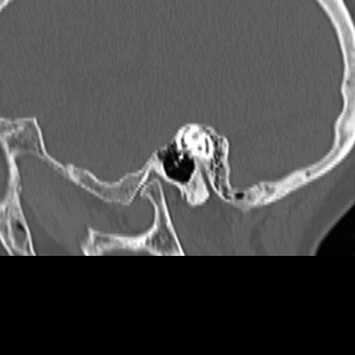 Bilateral tympanoplasty (Radiopaedia 16947-16664 Sagittal bone window 24).jpg