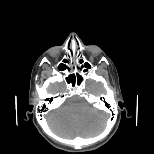 File:Bisphosphonate-related osteonecrosis of the jaw (Radiopaedia 71324-81642 non-contrast 167).jpg