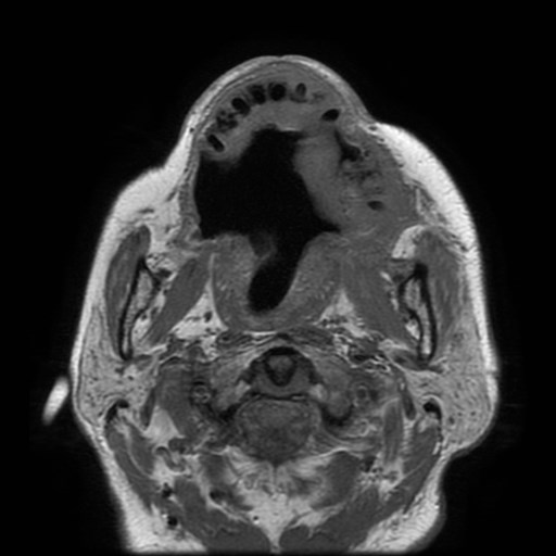 Bisphosphonate-related osteonecrosis of the maxilla (Radiopaedia 51367-57101 Axial T1 20).jpg
