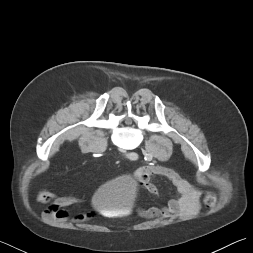 File:Bladder papillary urothelial carcinoma (Radiopaedia 48119-52951 Axial C+ delayed 38).png