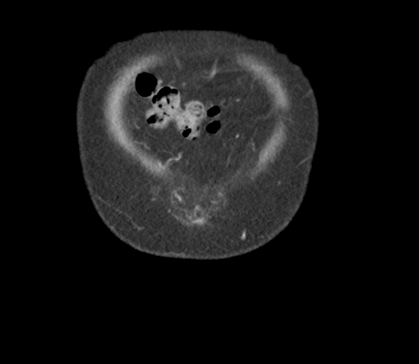 File:Bladder papillary urothelial carcinoma (Radiopaedia 48119-52951 C 5).png