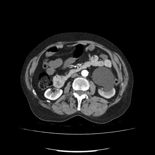File:Bladder tumor detected on trauma CT (Radiopaedia 51809-57609 A 114).jpg