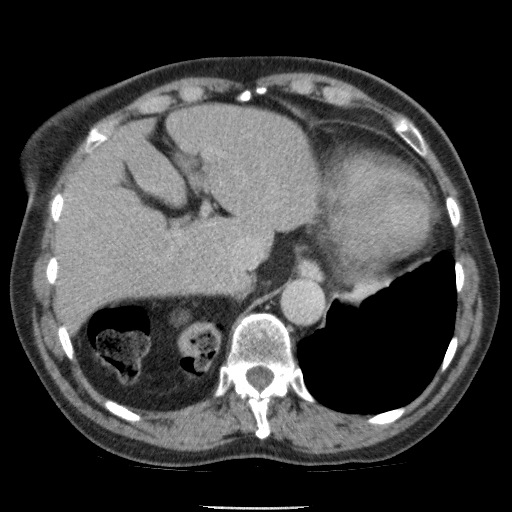 Bladder tumor detected on trauma CT (Radiopaedia 51809-57609 C 27).jpg