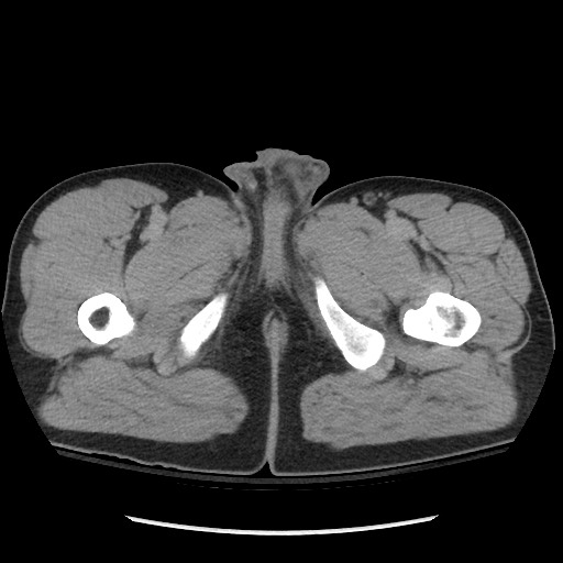 Blunt abdominal trauma with solid organ and musculoskelatal injury with active extravasation (Radiopaedia 68364-77895 Axial C+ delayed 153).jpg