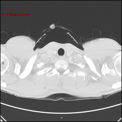 File:Blunt chest trauma - pulmonary interstitial emphysema and pneumomediastinum (Radiopaedia 20666-20552 Axial lung window 2).jpg