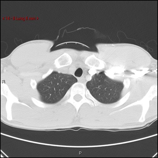 File:Blunt chest trauma - pulmonary interstitial emphysema and pneumomediastinum (Radiopaedia 20666-20552 Axial lung window 8).jpg