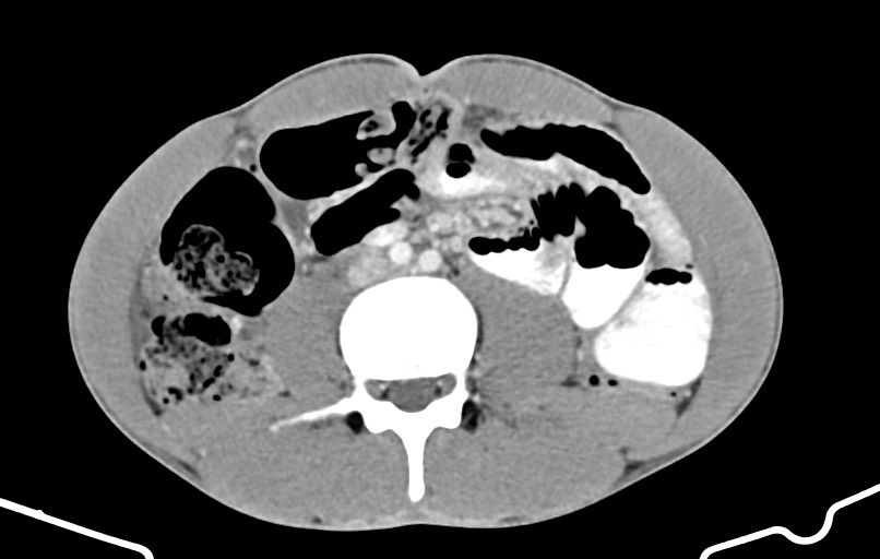 Blunt injury to the small bowel (Radiopaedia 74953-85987 A 102).jpg