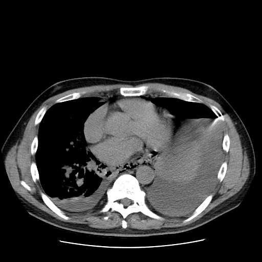 Boerhaave syndrome (Radiopaedia 59796-67310 Axial liver window 38).jpg