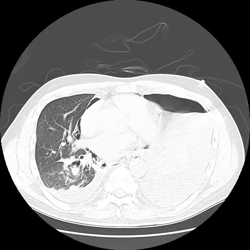 Boerhaave syndrome (Radiopaedia 59796-67310 Axial lung window 37).jpg