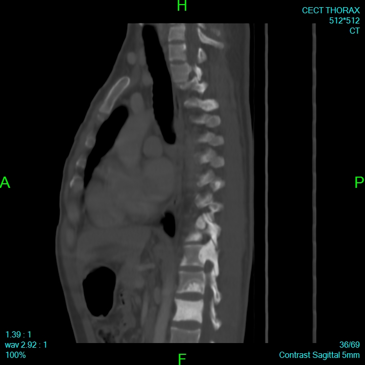 Bone metastases from lung carcinoma (Radiopaedia 54703-60937 Sagittal bone window 36).jpg