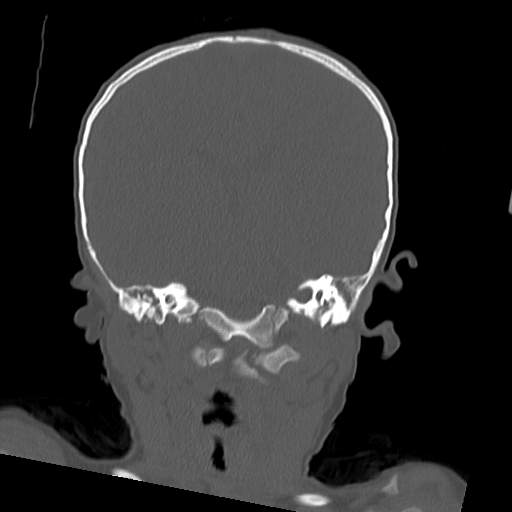 File:Bony atresia of the right external auditory canal (Radiopaedia 27916-28156 Coronal bone window 10).jpg
